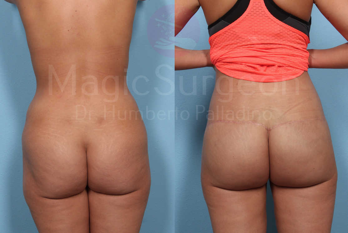 Buttock Lift Patient 04, before and after