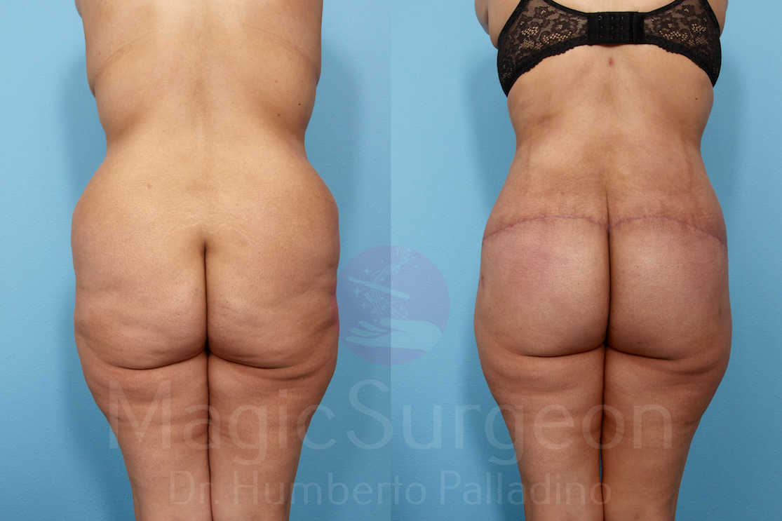 Buttock Lift Patient 05, before and after