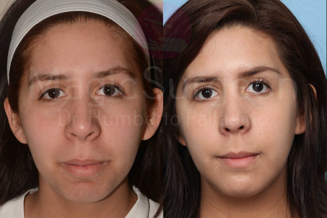Chin Augmentation Patient 01, before and after