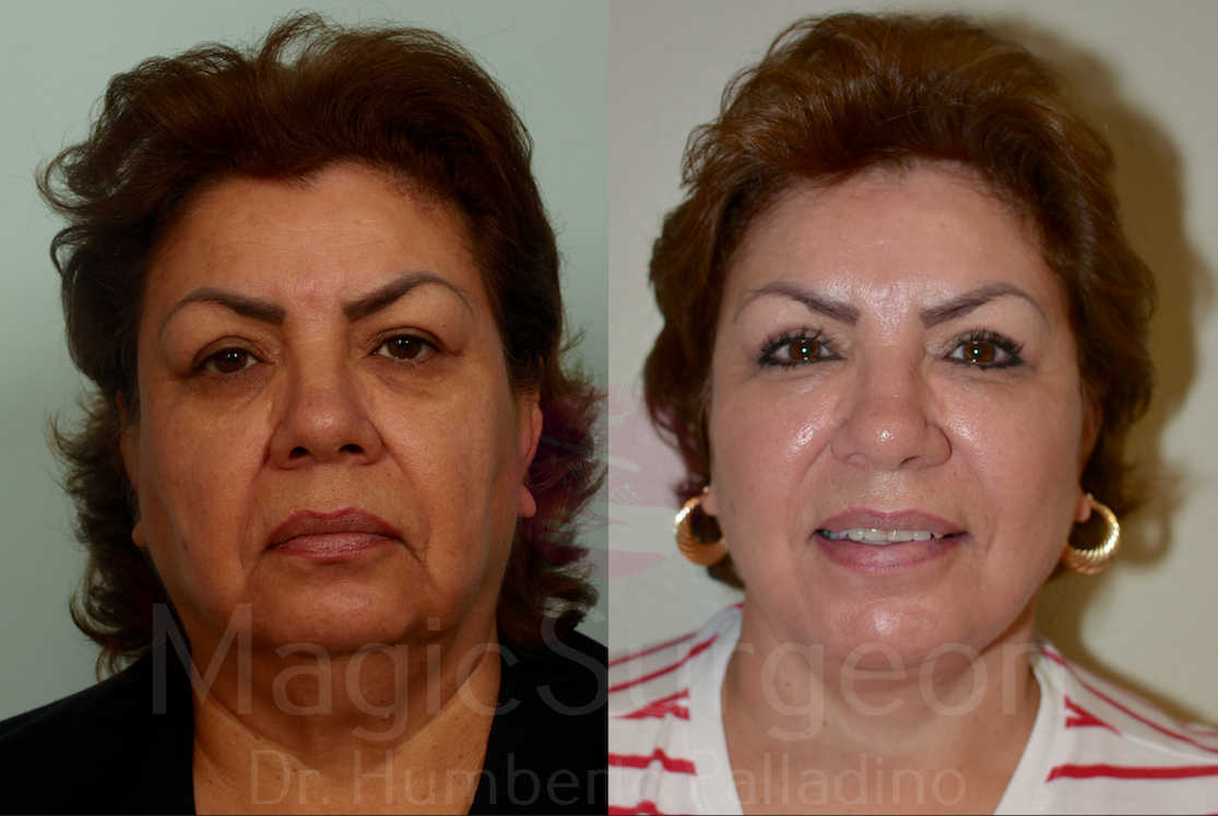 Facelift Patient 01, before and after