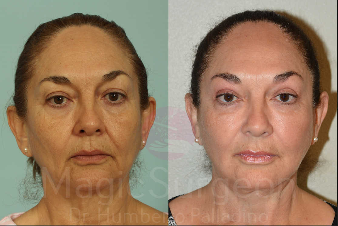 Facelift Patient 02, before and after