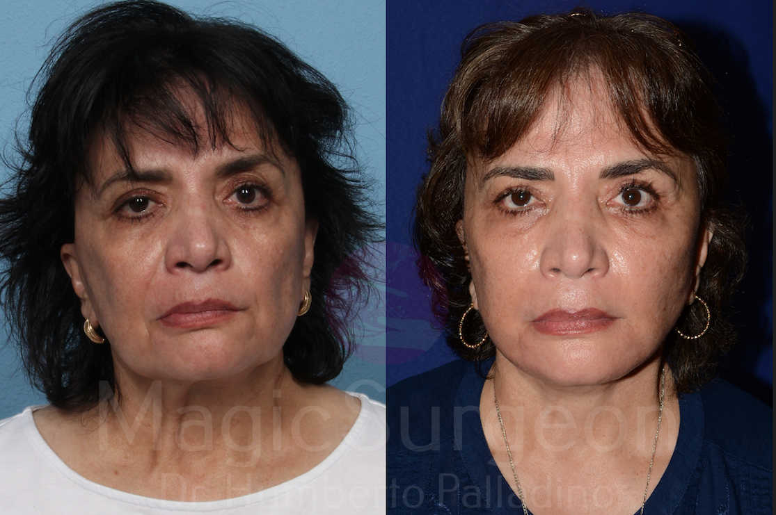 Facelift Patient 03, before and after