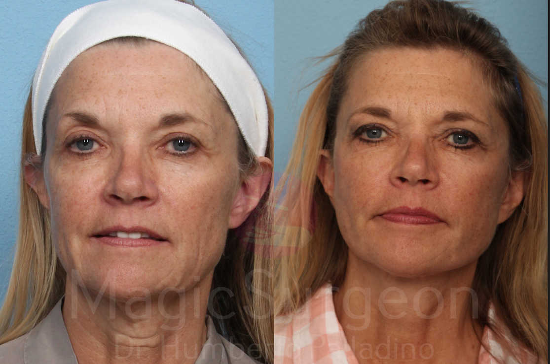 Facelift Patient 05, before and after