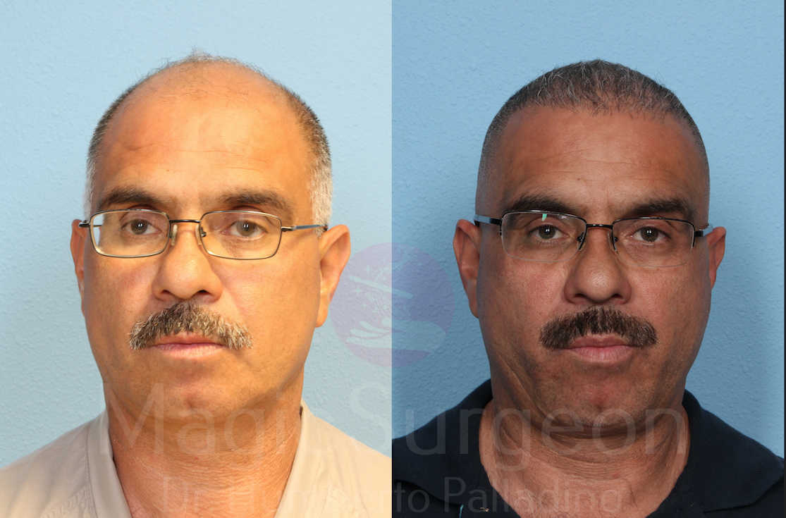 Hair Transplant Patient 01, before and after