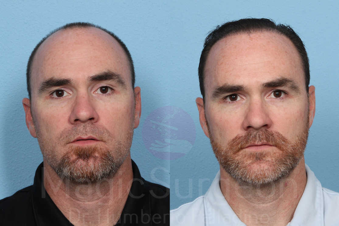 Hair Transplant Patient 02, before and after