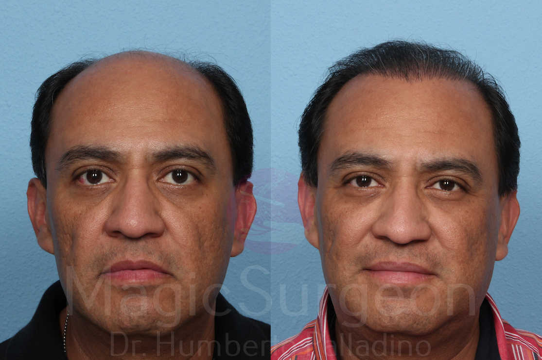 Hair Transplant Patient 03, before and after