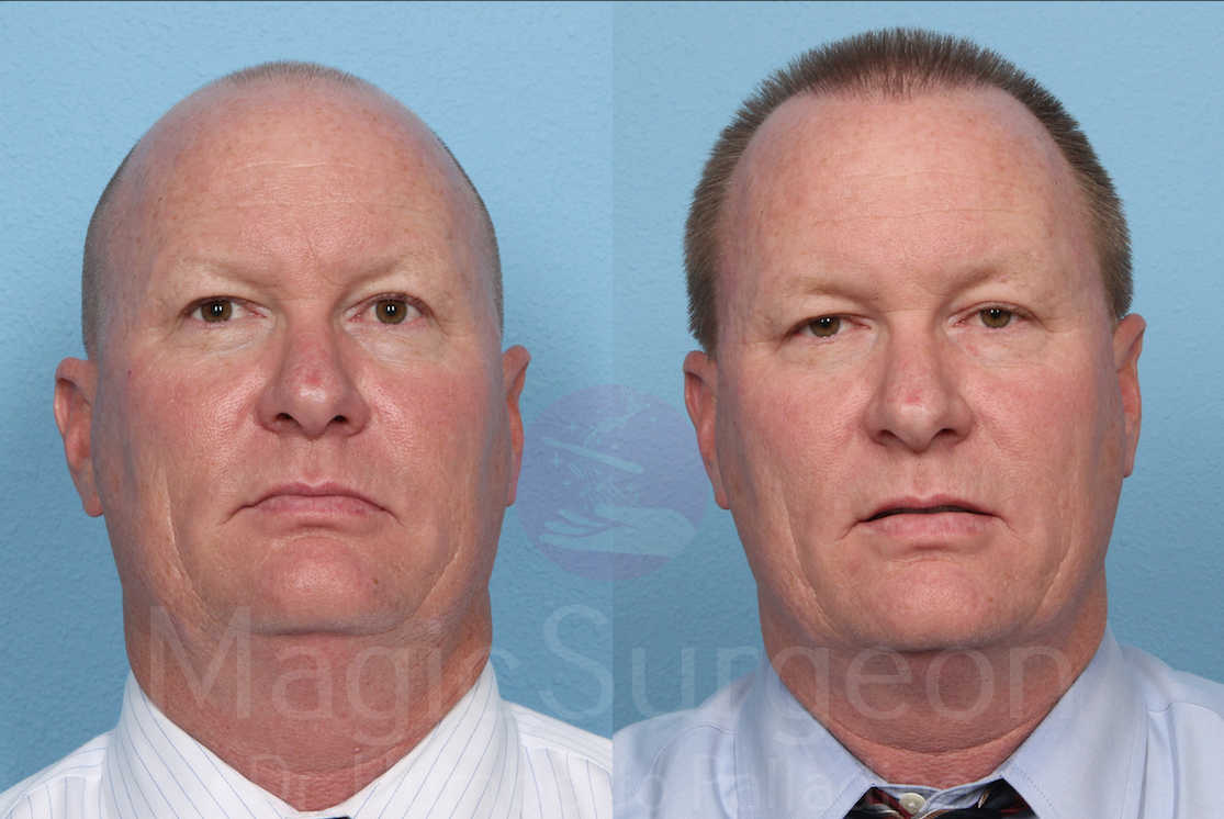 Hair Transplant Patient 04, before and after