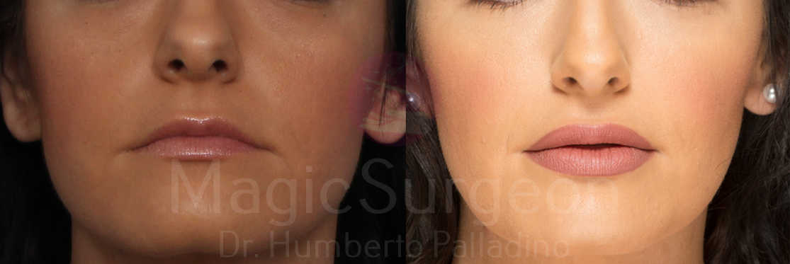 Lip Augmentation Patient 01, before and after