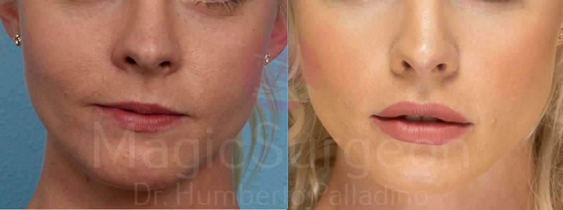 Lip Augmentation Patient 02, before and after