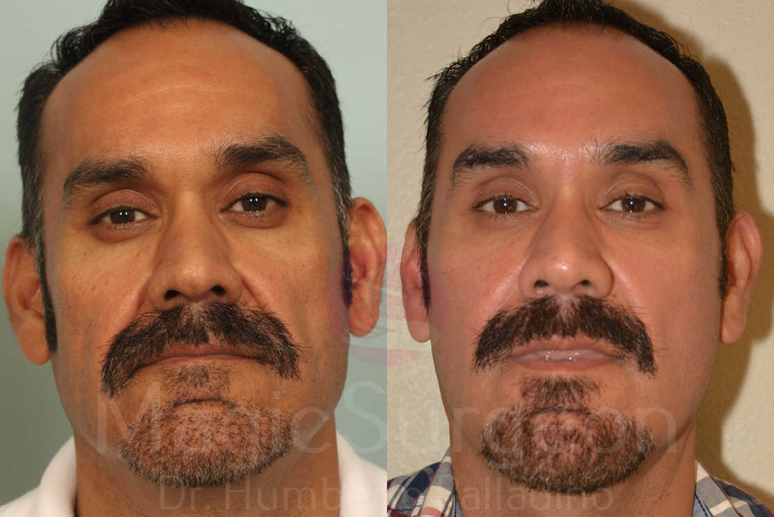Male Facial Rejuvenation Patient 01, before and after