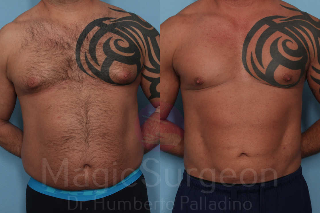 Male HD Liposculpture Patient 01, before and after