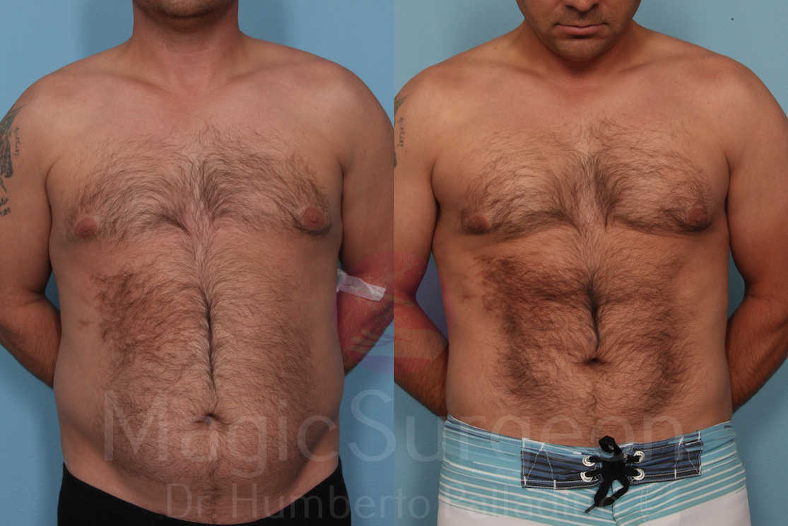 Male HD Liposculpture Patient 02, before and after