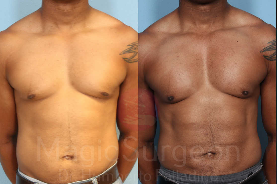 Male HD Liposculpture Patient 03, before and after