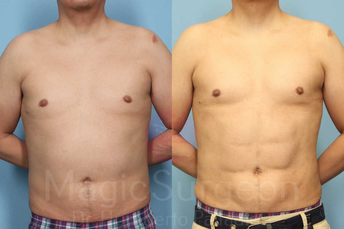 Male HD Liposculpture Patient 04, before and after