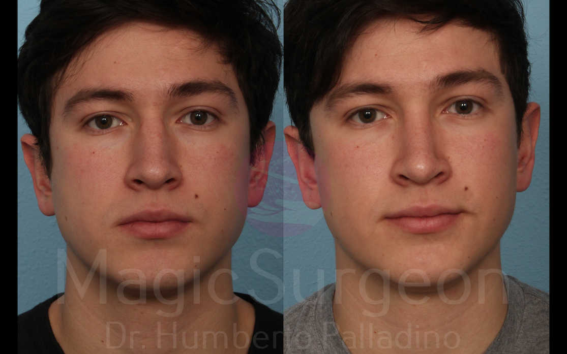 Men’s Rhinoplasty Patient 02, before and after