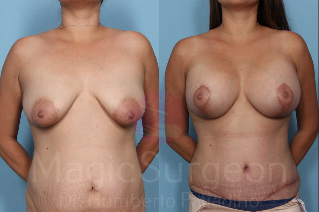 Mommy Makeover Patient 03, before and after