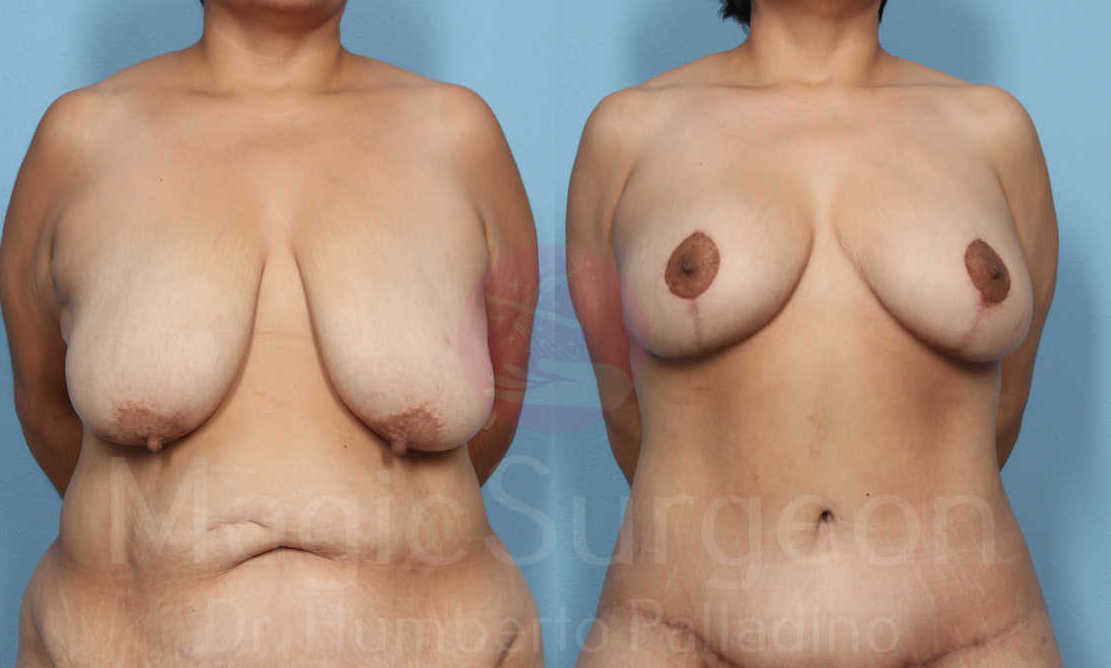 Mommy Makeover Patient 04, before and after
