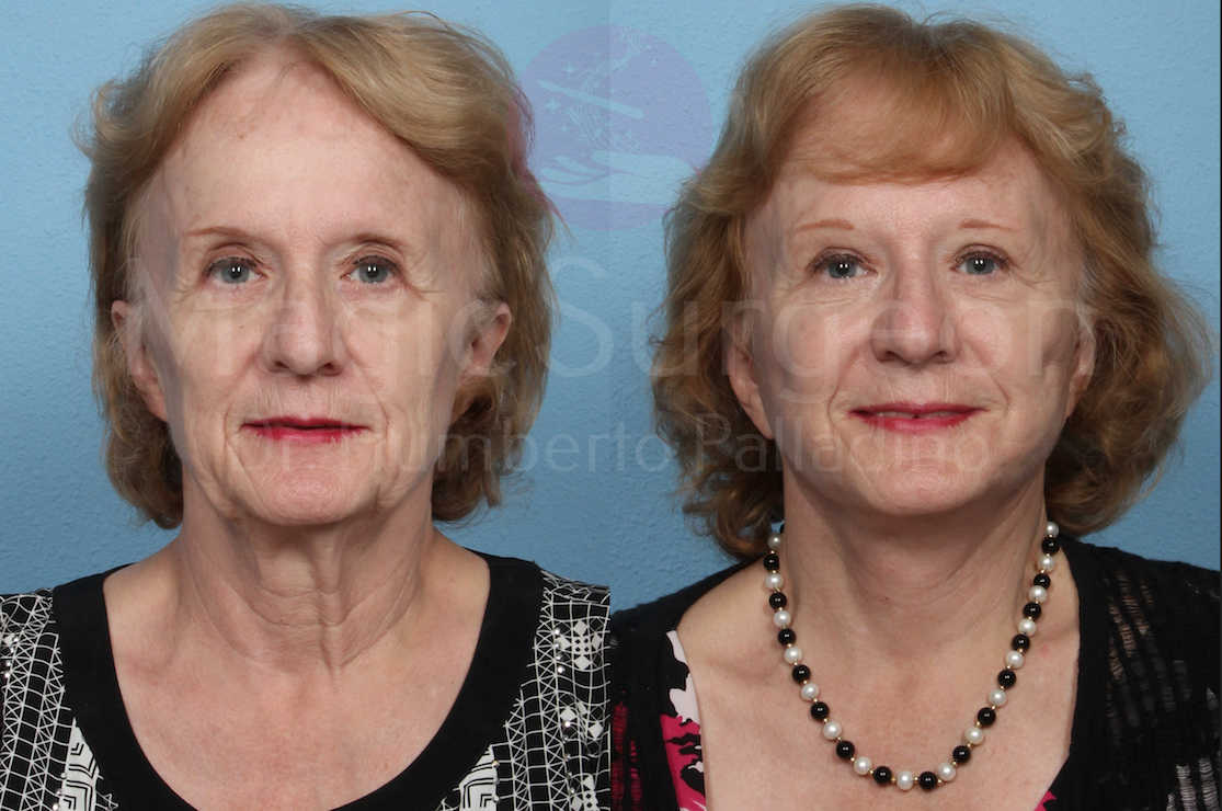Neck Lift Patient 01, before and after