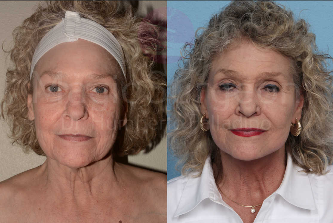 Neck Lift Patient 02, before and after