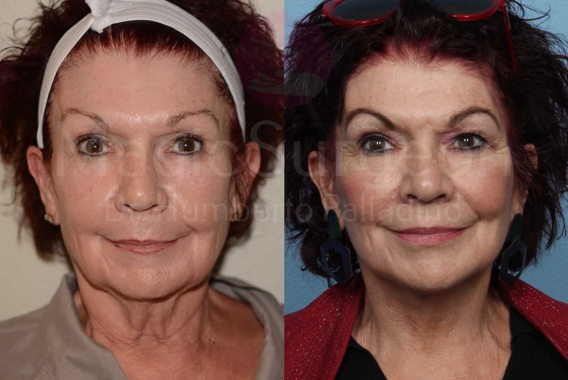 Neck Lift Patient 03, before and after