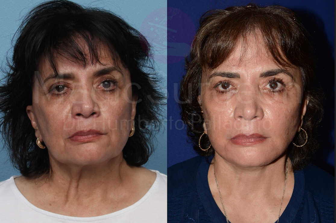 Neck Lift Patient 04, before and after