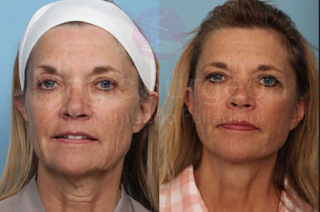 Neck Lift Patient 05, before and after