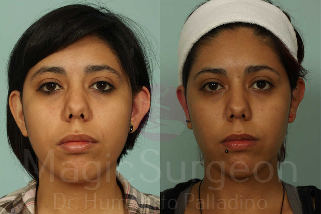 Otoplasty Patient 01, before and after