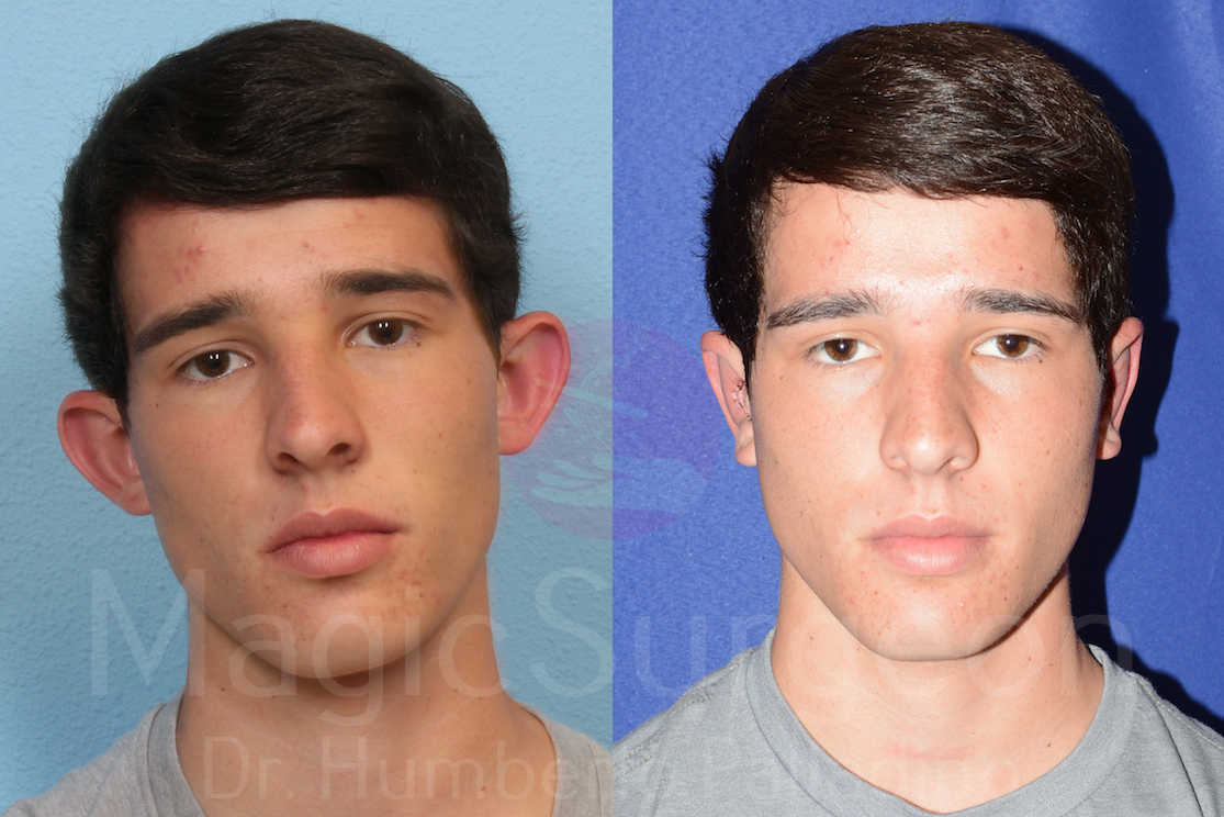 Otoplasty Patient 02, before and after