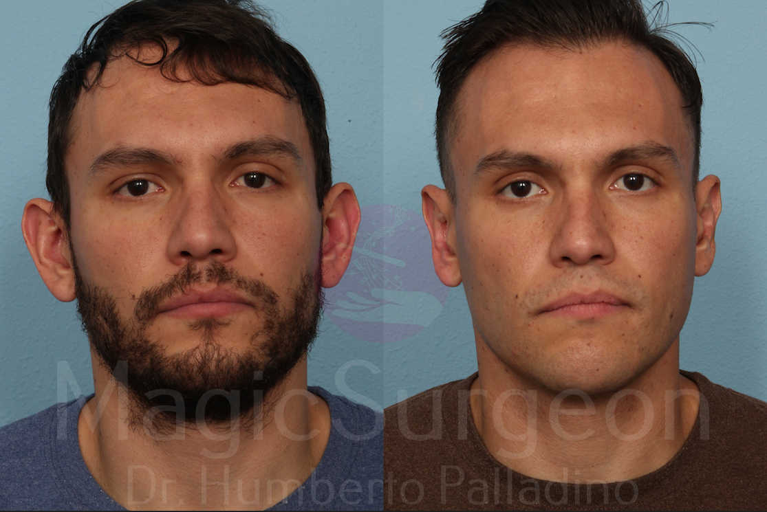 Otoplasty Patient 03, before and after