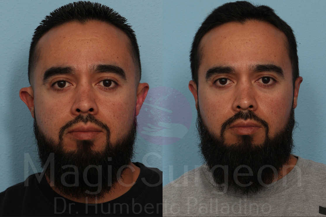 Otoplasty Patient 04, before and after
