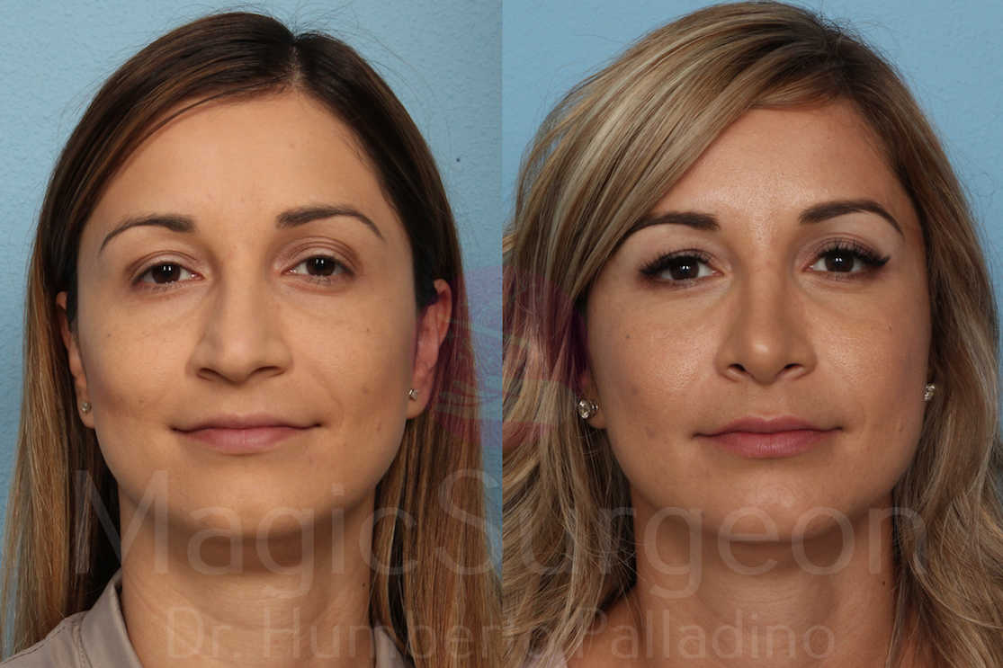 Rhinoplasty Patient 10, before and after
