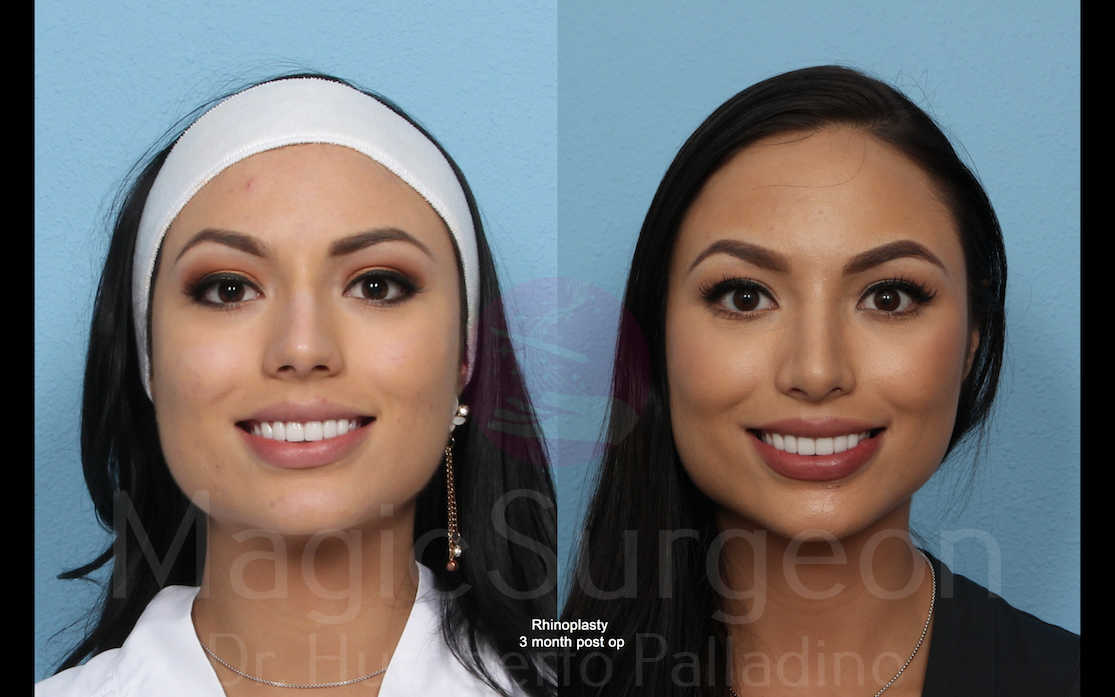 Rhinoplasty Patient 01, before and after