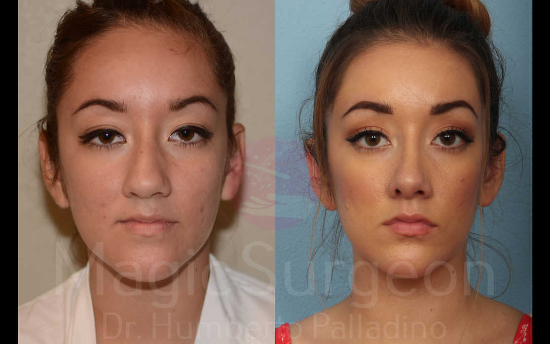 Rhinoplasty Patient 02, before and after