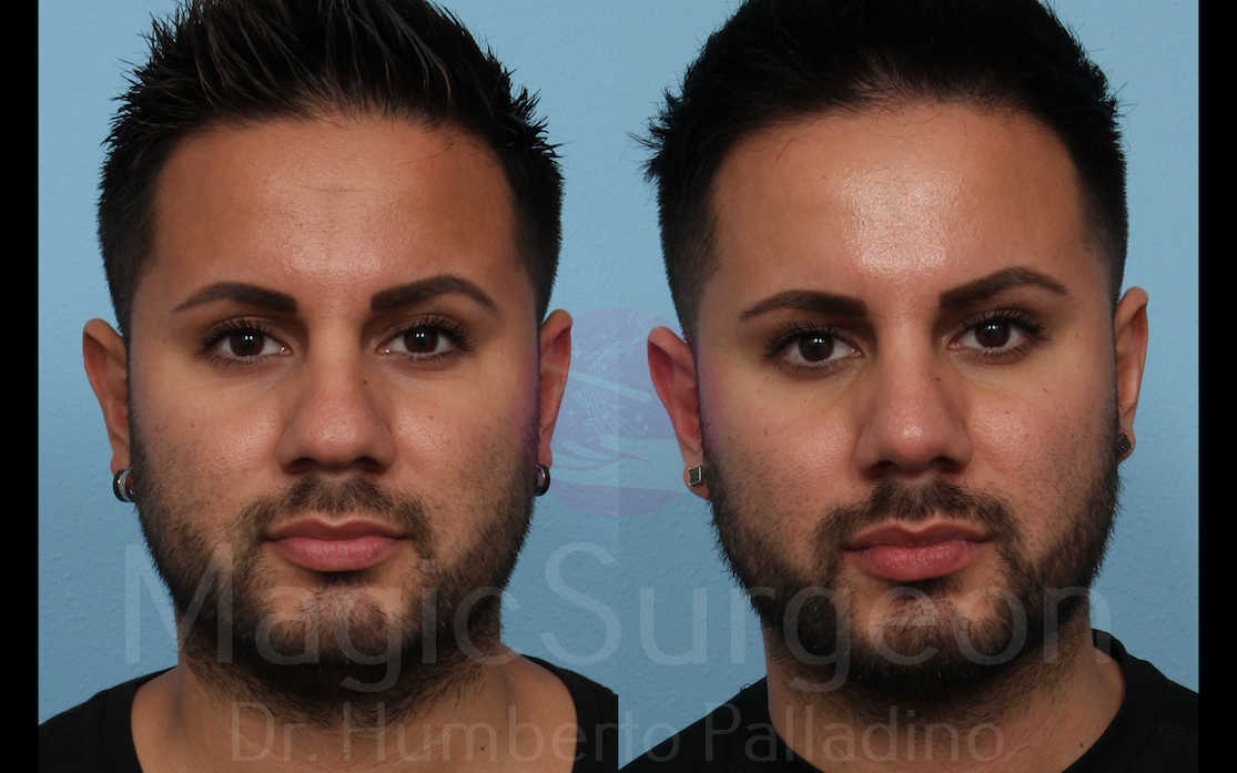 Rhinoplasty Patient 03, before and after