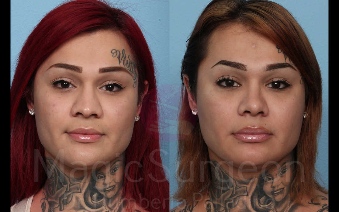 Rhinoplasty Patient 04, before and after