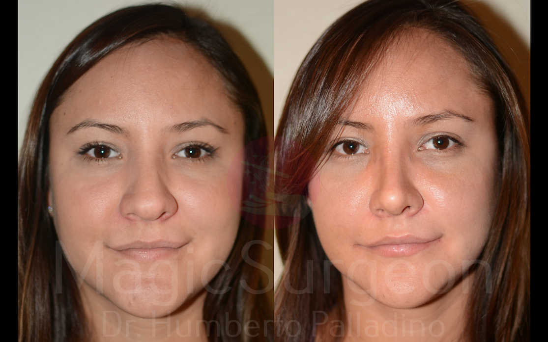 Rhinoplasty Patient 05, before and after
