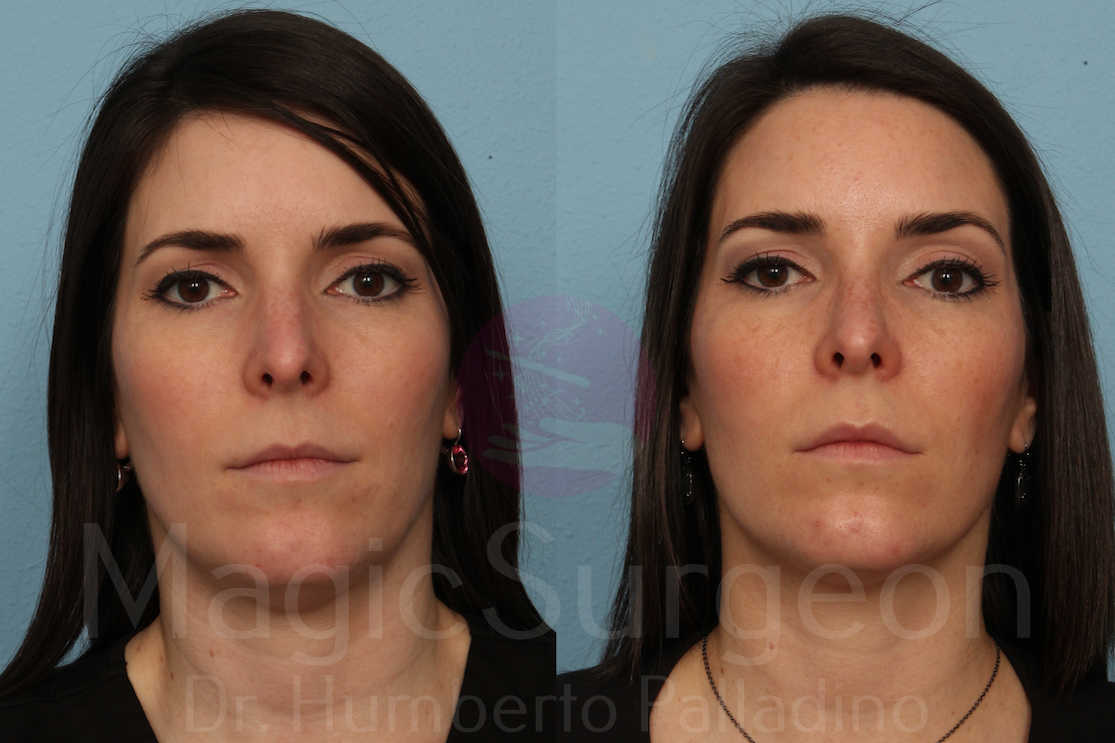 Rhinoplasty Patient 07, before and after
