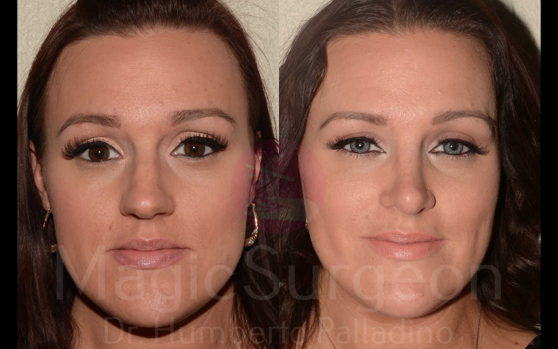 Rhinoplasty Patient 08, before and after