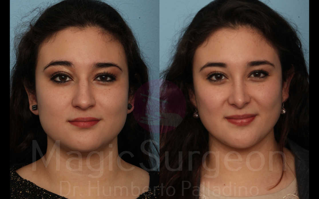 Rhinoplasty Patient 09, before and after