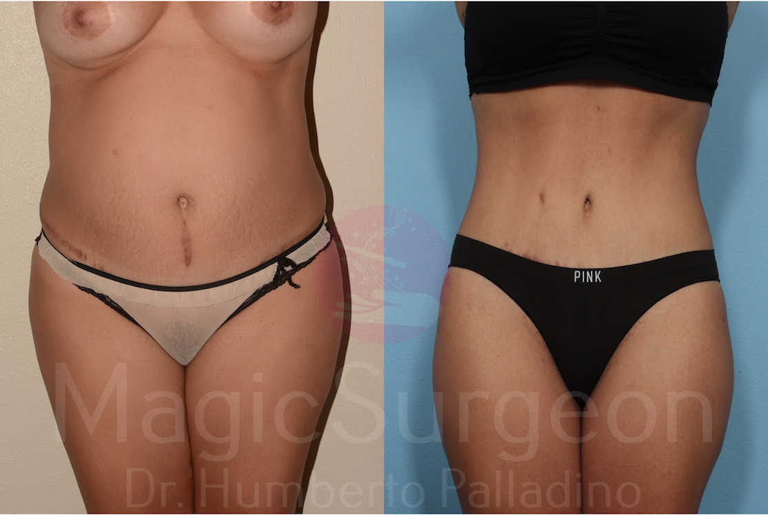 Tummy Tuck Patient 01, before and after