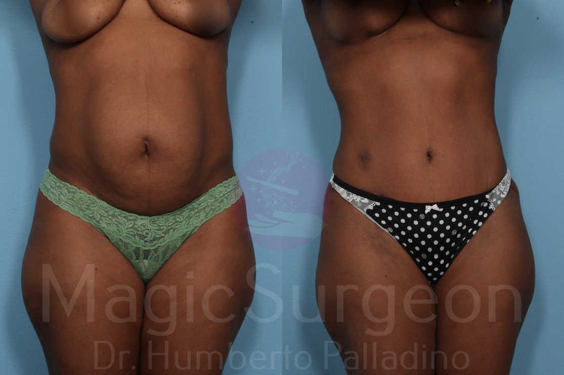 Tummy Tuck Patient 02, before and after