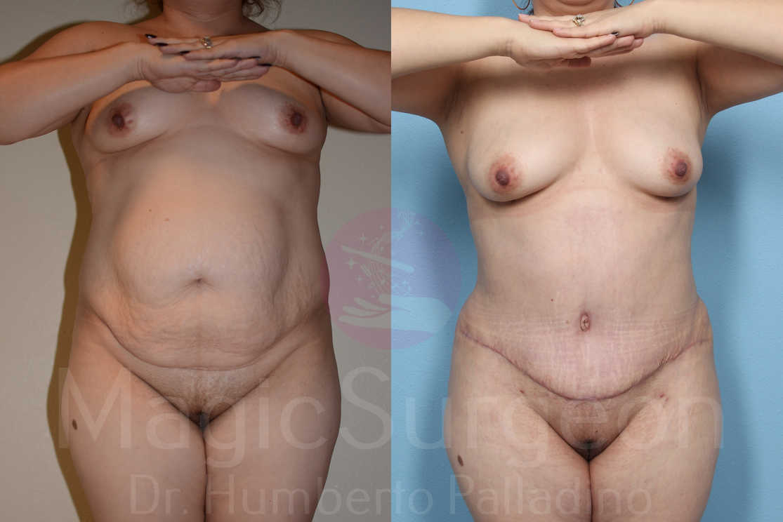 Tummy Tuck Patient 03, before and after