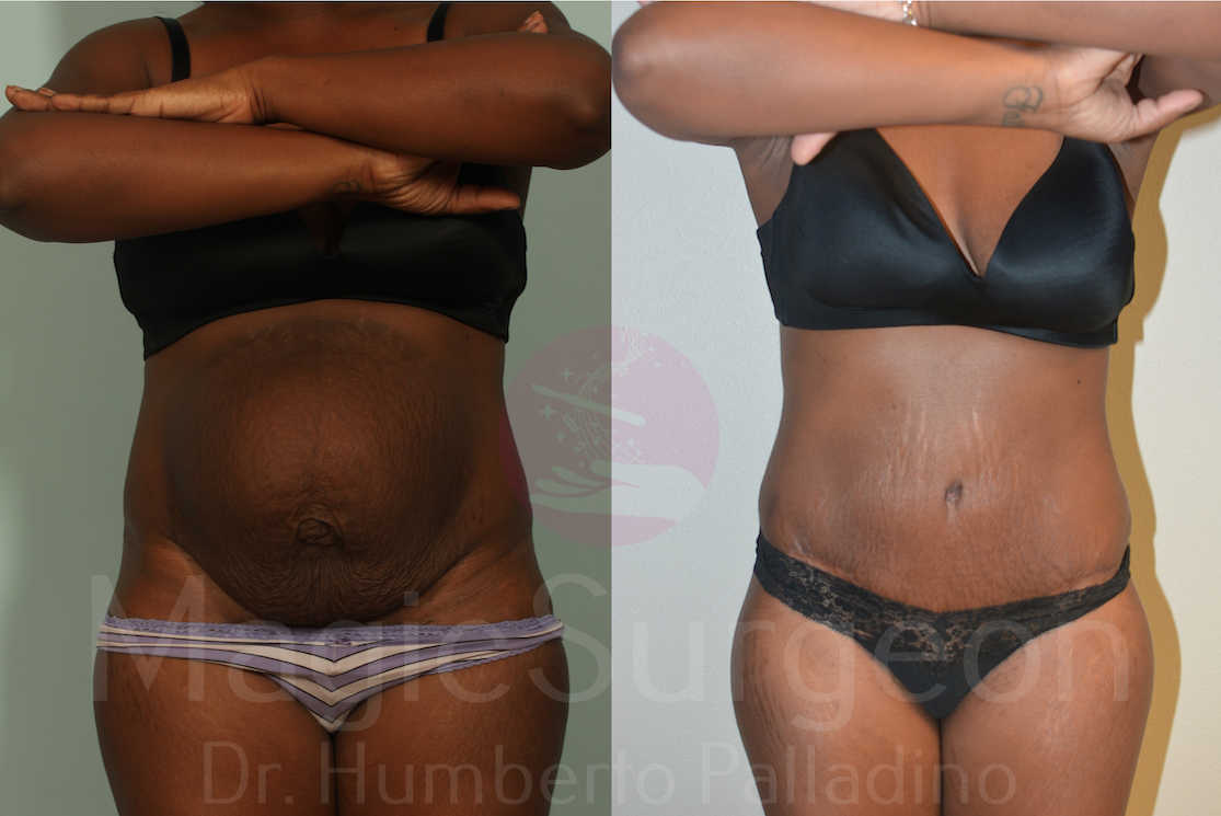 Tummy Tuck Patient 04, before and after