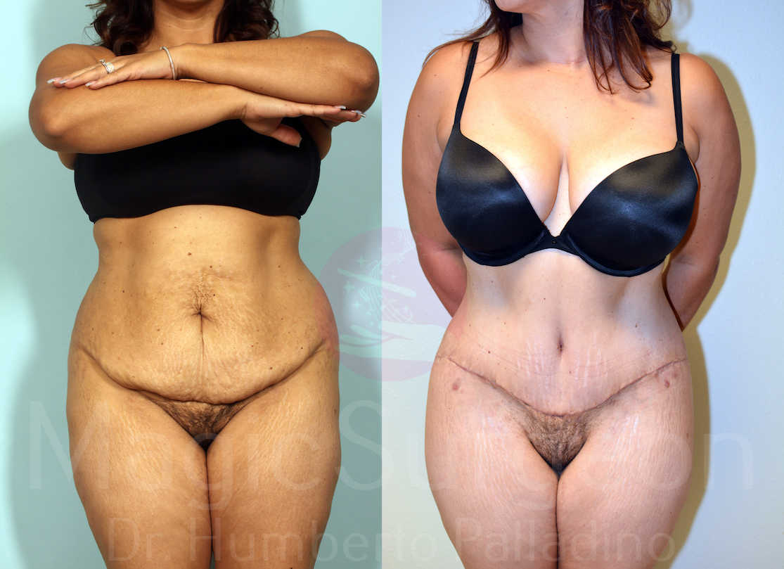Tummy Tuck Patient 05, before and after